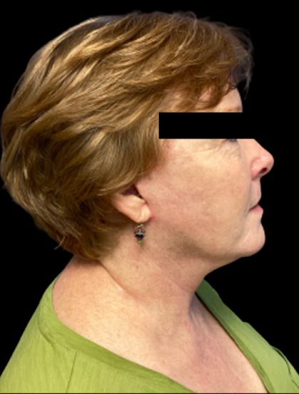 Facelift Before & After Patient #6092