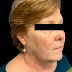 Facelift Before & After Patient #6092