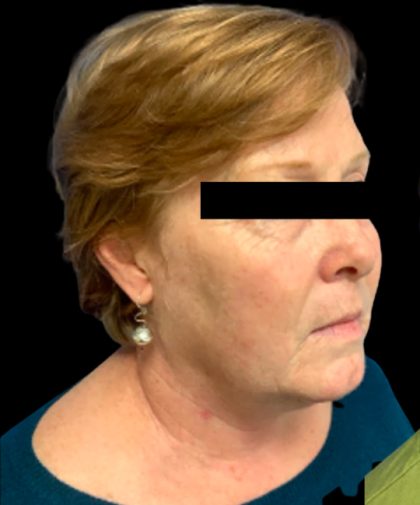 Facelift Before & After Patient #6092