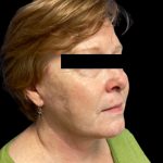 Facelift Before & After Patient #6092