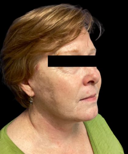 Facelift Before & After Patient #6092