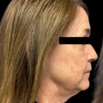 Facelift Before & After Patient #6094