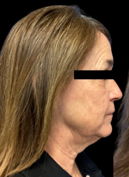 Facelift Before & After Patient #6094