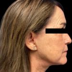 Facelift Before & After Patient #6094