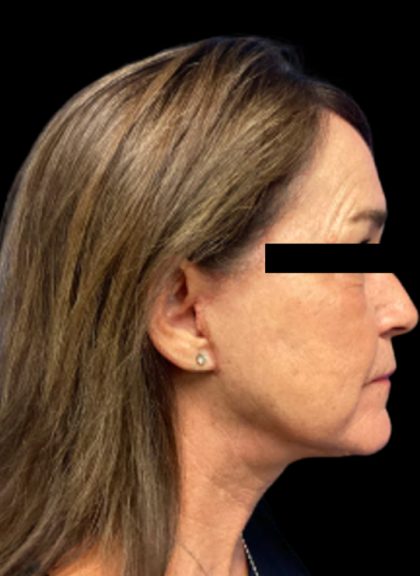 Facelift Before & After Patient #6094