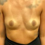 Breast Fat Grafting Before & After Patient #5851
