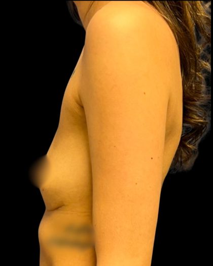 Breast Fat Grafting Before & After Patient #5851
