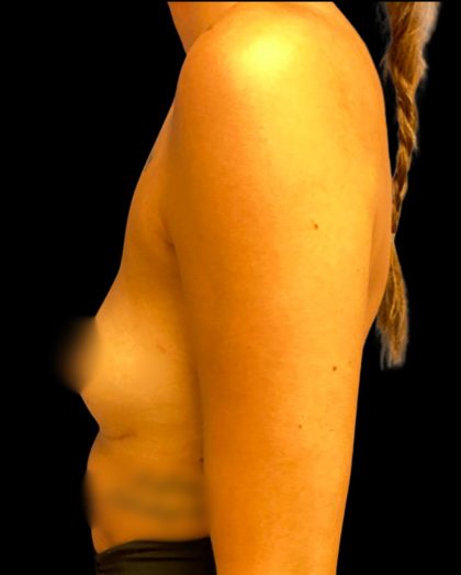 Breast Fat Grafting Before & After Patient #5851