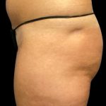 Fat Grafting Buttocks Before & After Patient #5852