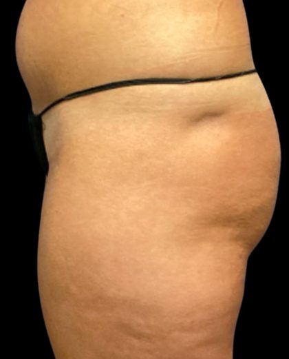 Fat Grafting Buttocks Before & After Patient #5852
