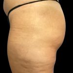 Fat Grafting Buttocks Before & After Patient #5852