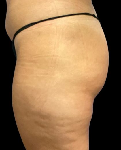 Fat Grafting Buttocks Before & After Patient #5852
