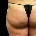 Fat Grafting Buttocks Before & After Patient #5852