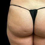 Fat Grafting Buttocks Before & After Patient #5852