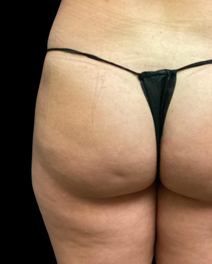 Fat Grafting Buttocks Before & After Patient #5852