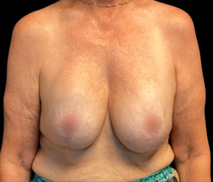 Implant Removal Before & After Patient #6000