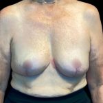 Implant Removal Before & After Patient #6000