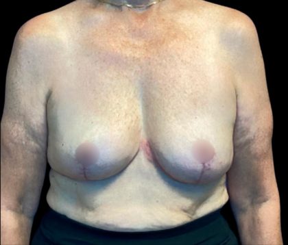 Implant Removal Before & After Patient #6000