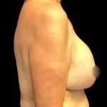 Implant Removal Before & After Patient #6000
