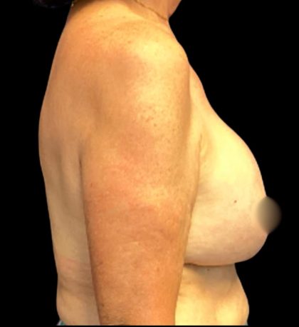 Implant Removal Before & After Patient #6000