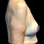 Implant Removal Before & After Patient #6000