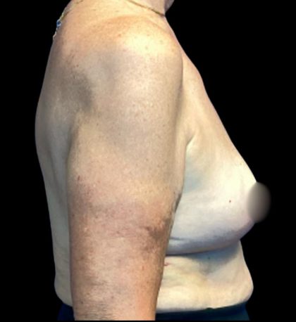 Implant Removal Before & After Patient #6000