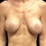 Implant Removal Before & After Patient #5999
