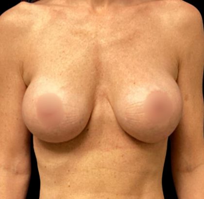 Implant Removal Before & After Patient #5999