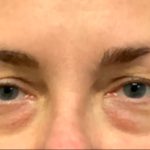 Blepharoplasty Before & After Patient #6095