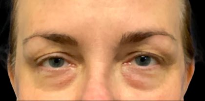 Blepharoplasty Before & After Patient #6095