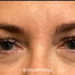 Blepharoplasty Before & After Patient #6095