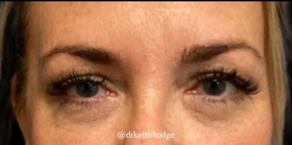 Blepharoplasty Before & After Patient #6095