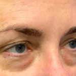 Blepharoplasty Before & After Patient #6095