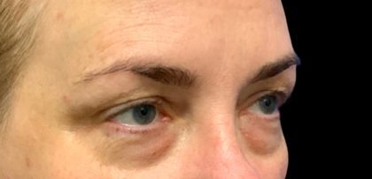 Blepharoplasty Before & After Patient #6095