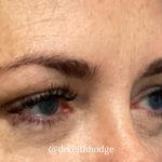 Blepharoplasty Before & After Patient #6095
