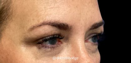 Blepharoplasty Before & After Patient #6095