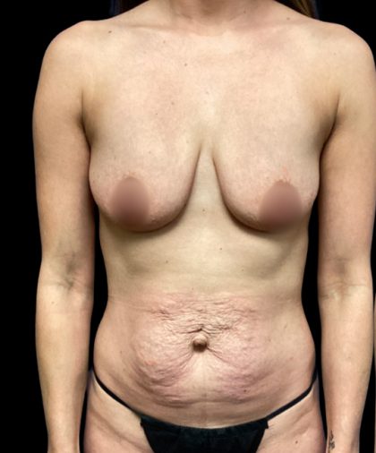 Mommy Makeover Before & After Patient #6096