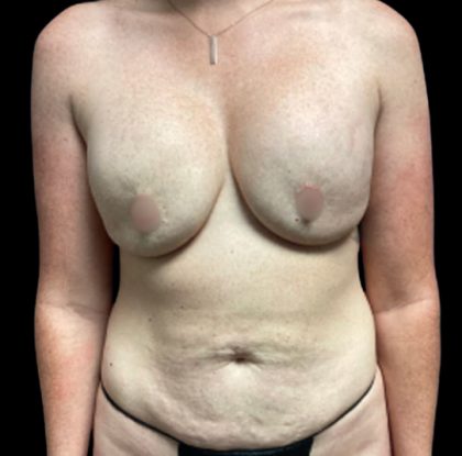 Mommy Makeover Before & After Patient #6097