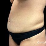 Mommy Makeover Before & After Patient #6097