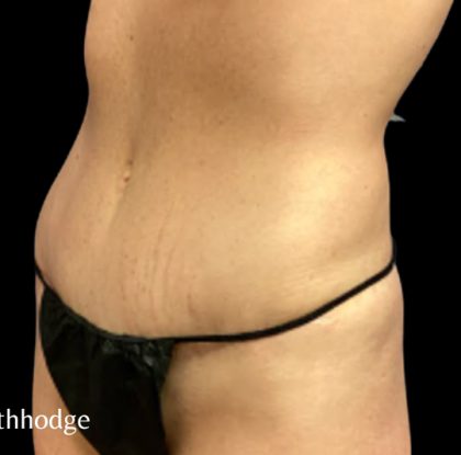 Mommy Makeover Before & After Patient #6097