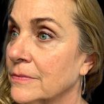 Blepharoplasty Before & After Patient #6098
