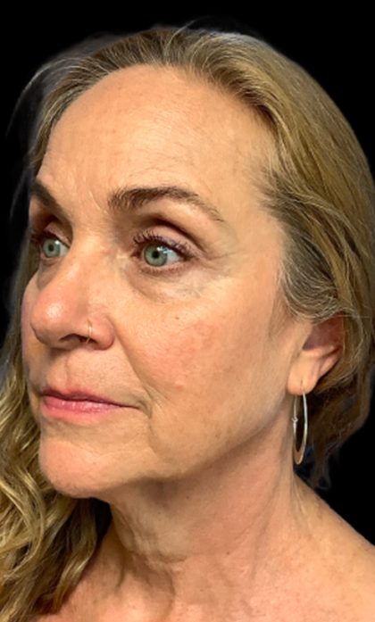 Blepharoplasty Before & After Patient #6098