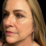 Blepharoplasty Before & After Patient #6098