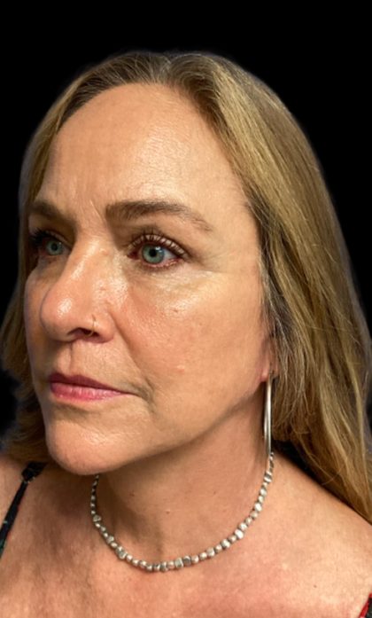 Blepharoplasty Before & After Patient #6098
