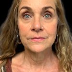 Blepharoplasty Before & After Patient #6098