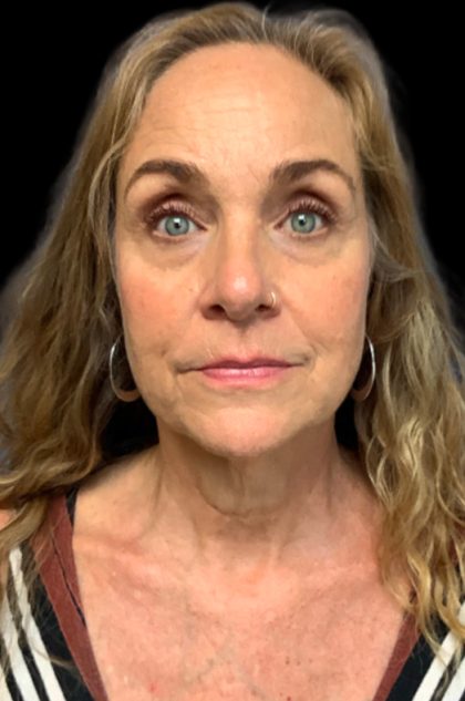 Blepharoplasty Before & After Patient #6098