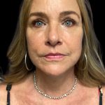 Blepharoplasty Before & After Patient #6098