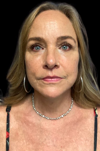 Blepharoplasty Before & After Patient #6098