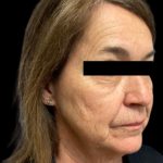 Facelift Before & After Patient #6094