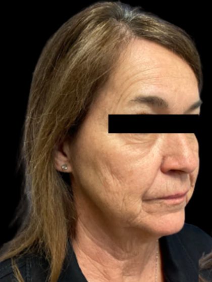Facelift Before & After Patient #6094